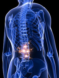 Low back pain